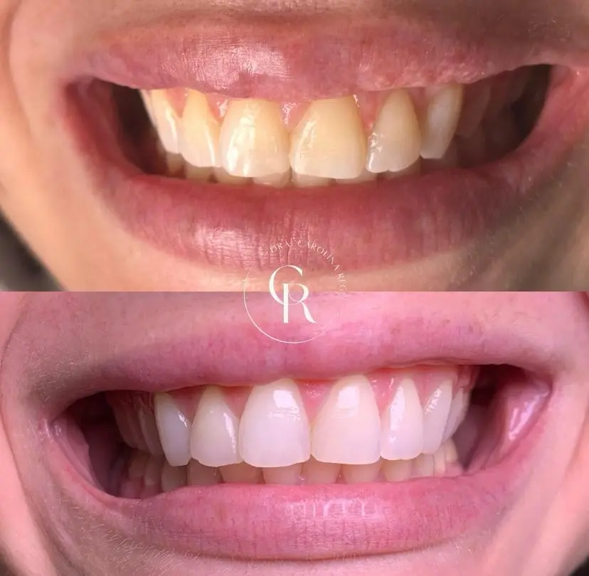 Antes e depois de um clareamento dental, exibindo dentes visivelmente mais brancos