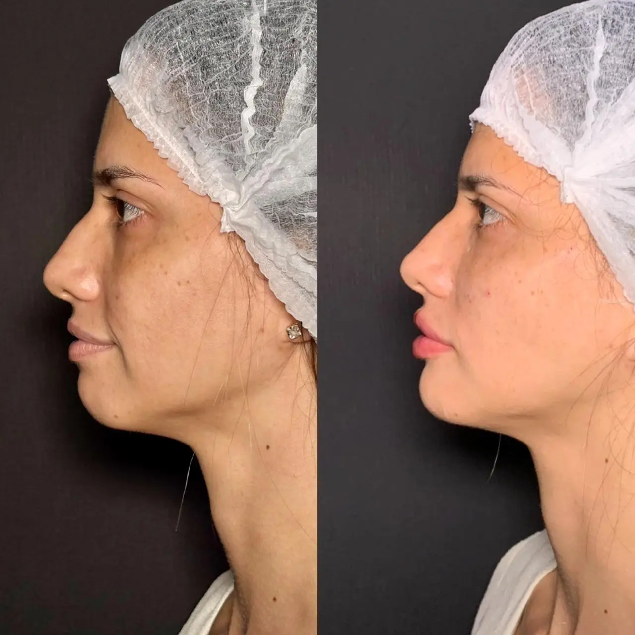 Resultado de procedimento de Harmonização Orofacial com melhor simetria facial