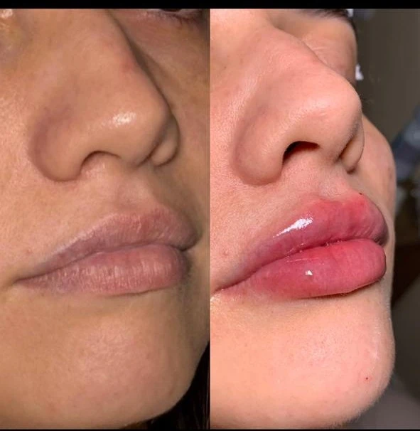 Antes e depois de preenchimento labial, demonstrando ganho de volume e contorno natural